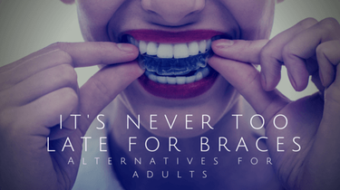 It’s Never Too Late For Braces – Alternatives for Adults